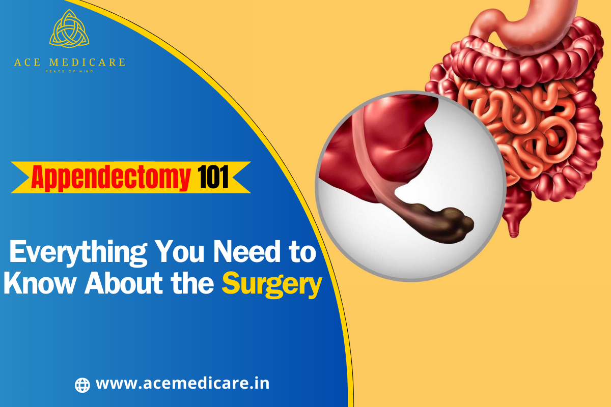 Appendectomy 101: Everything You Need to Know About the Surgery